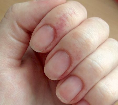 Признаки ожога ногтя
