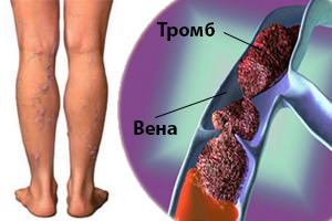 Лечение тромбоза глубоких вен