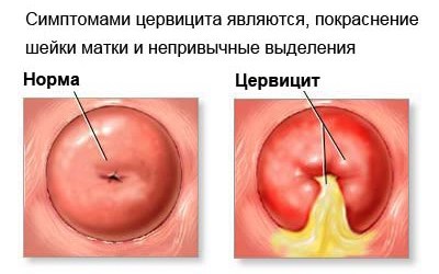 Симптомы эндоцервицита