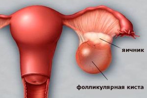 Фолликулярная киста яичника