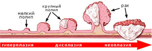 Лечение полипов в ММЦ ОН КЛИНИК