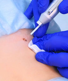 Удаление папиллом на теле