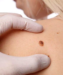 Удаление папиллом у женщин