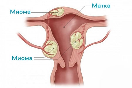 Миома матки