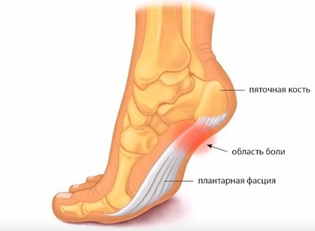 Пяточная шпора