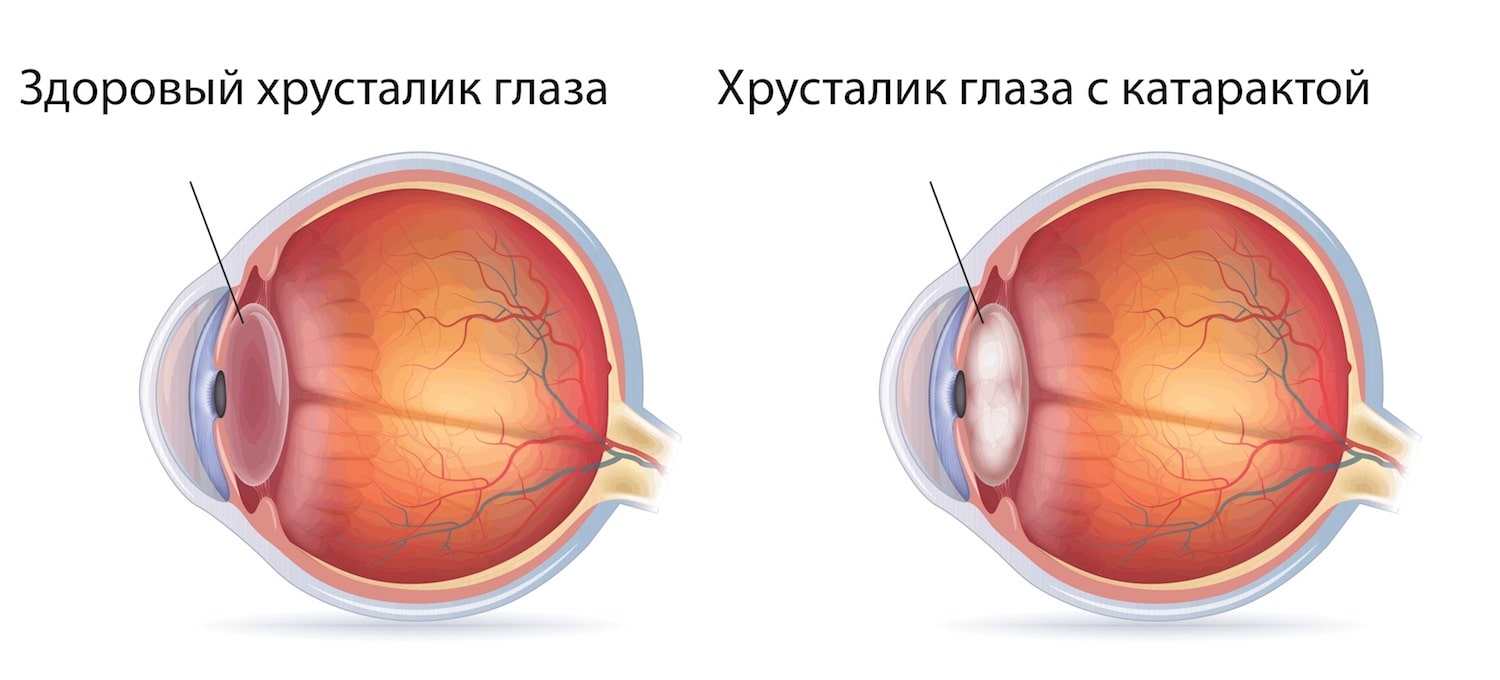 Катаракта