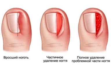 Удаление вросшего ногтя
