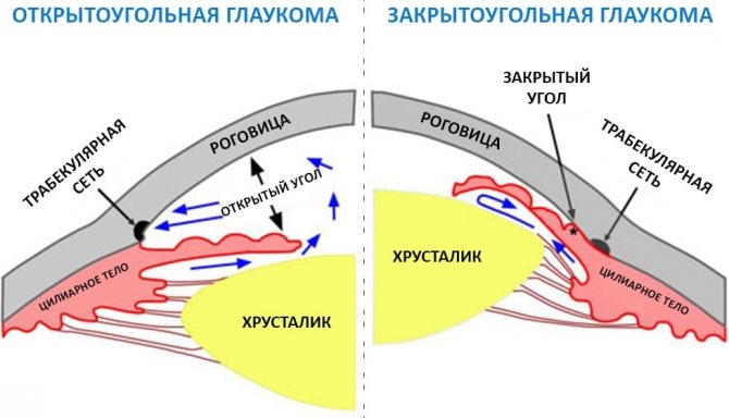 Отличие открытоугольной глаукомы от закрытоугольной