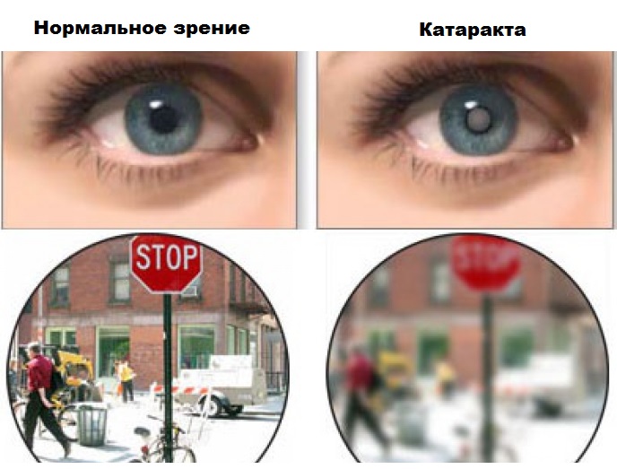 Признаки катаракты